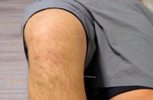 knee arthritis and acupuncture grey bruce